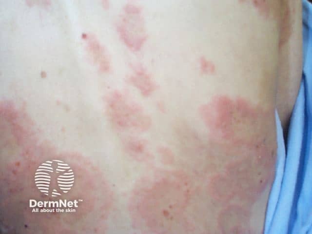 Bullous pemphigoid