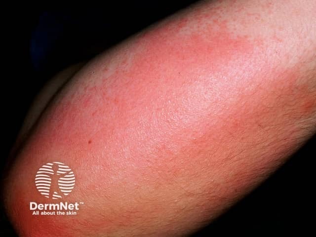 Pressure urticaria