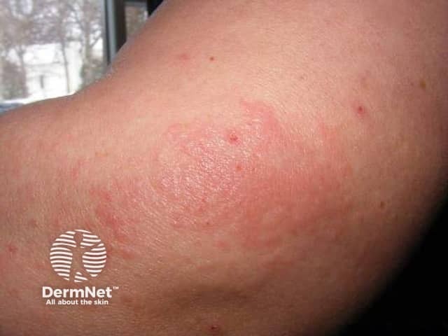 Autoimmune progesterone dermatitis: dermatitis presentation