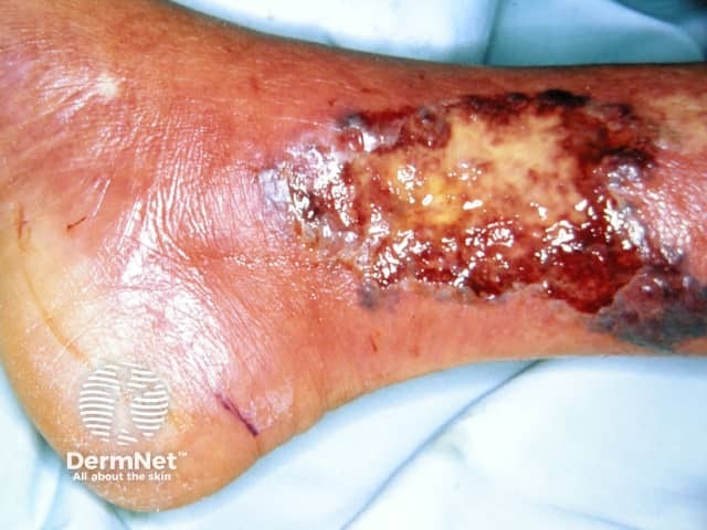 Pyoderma gangrenosum