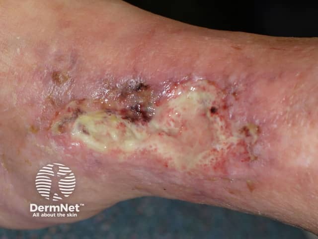 Pyoderma gangrenosum