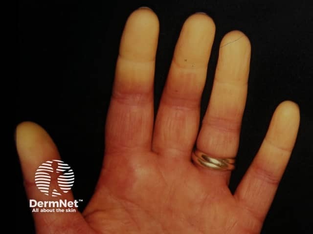 White phase of Raynaud phenomenon