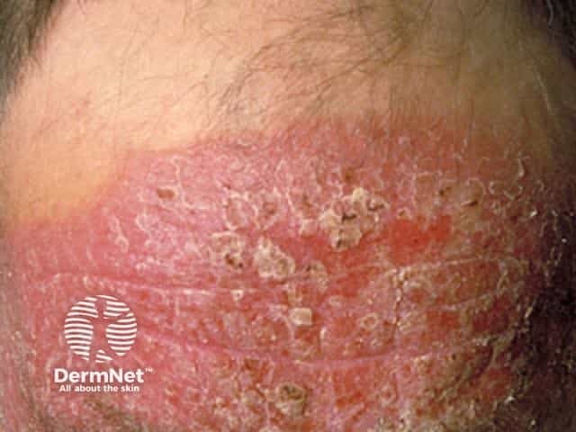 Chronic actinic dermatitis