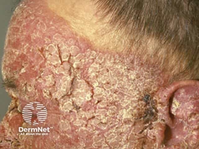 Chronic actinic dermatitis