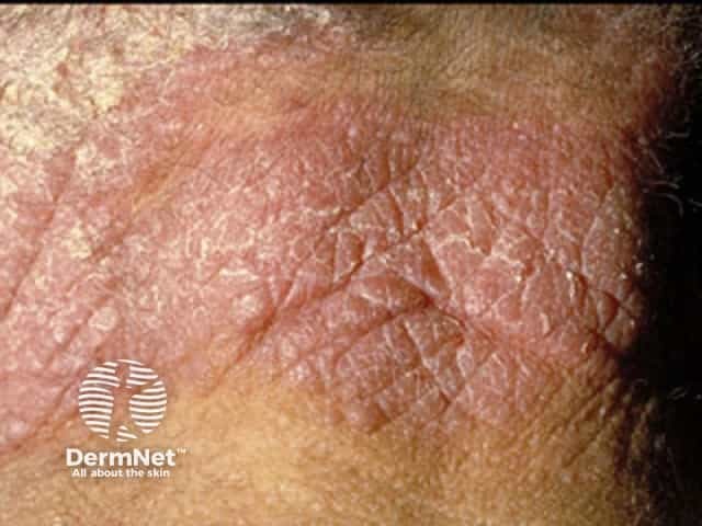 Chronic actinic dermatitis