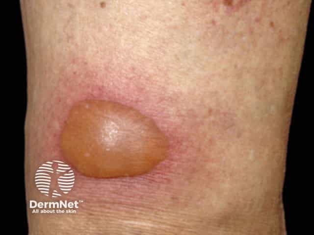 Blistering fixed drug eruption