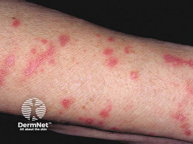 Plant contact dermatitis