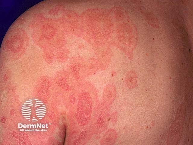 Targetoid lesion in urticaria