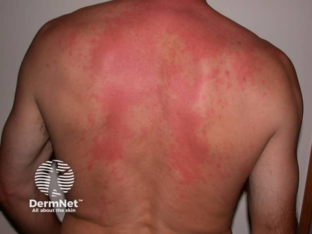 Scombroid rash