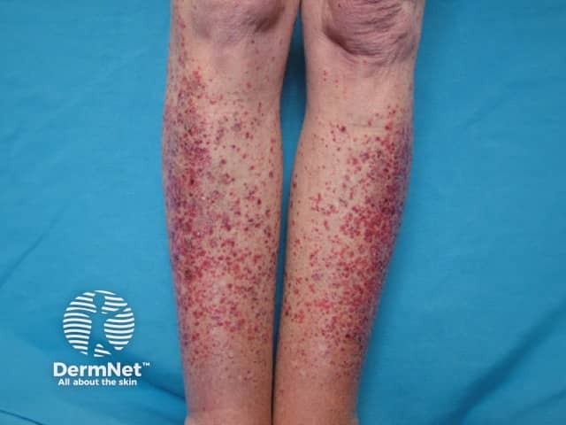 Hypersensitivity vasculitis