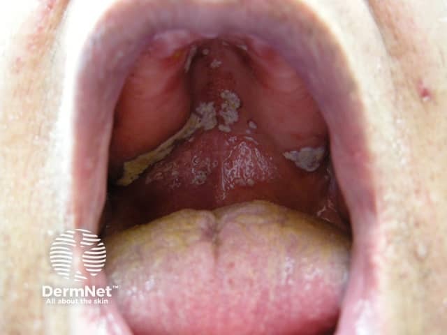 Oral candidiasis