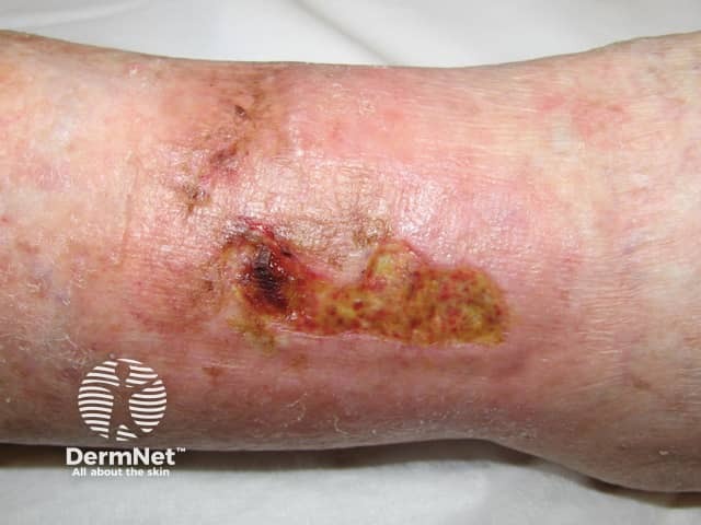 Venous ulcer