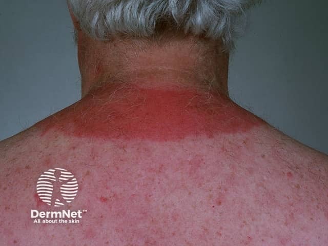 Solar urticaria