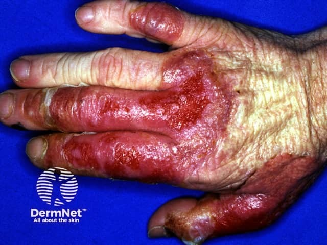 Pustular vasculitis