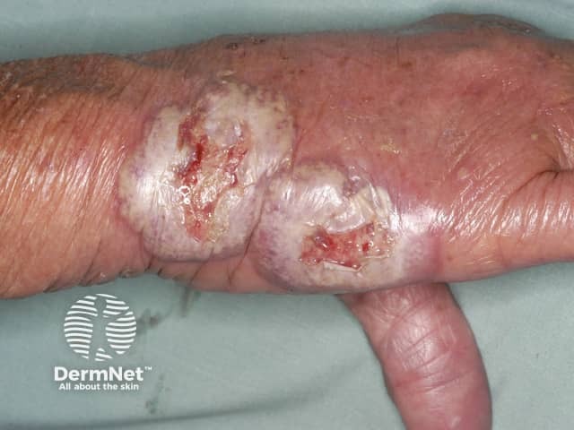 Pustular vasculitis