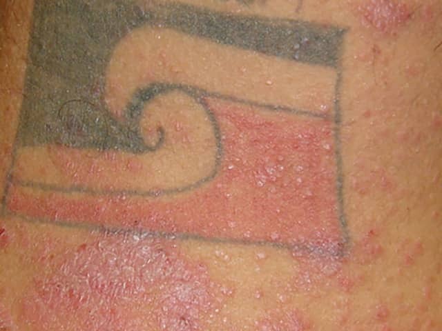 Lichenoid reaction to red tattoo pigment