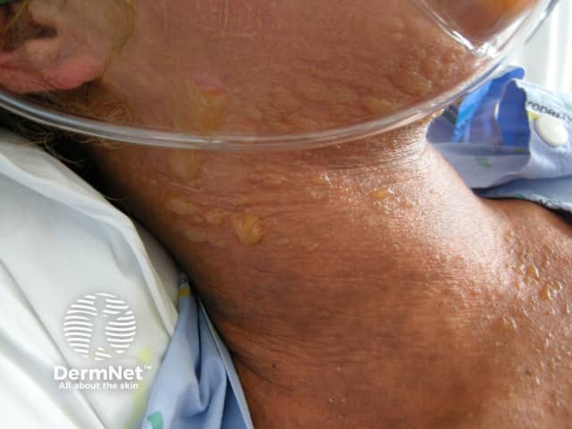 Toxic epidermal necrolysis