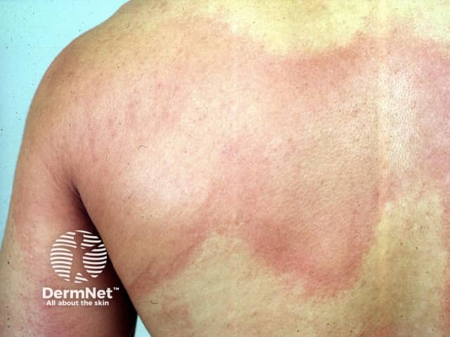 Urticaria