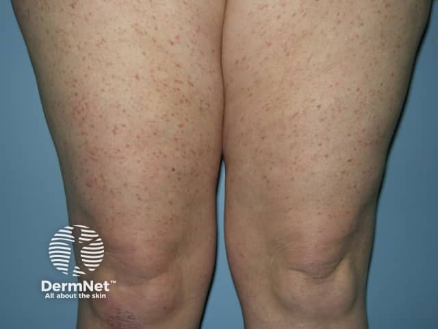 Urticaria pigmentosa: brown spots that urticate