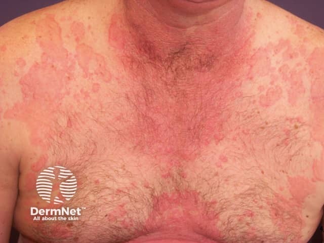 Urticaria