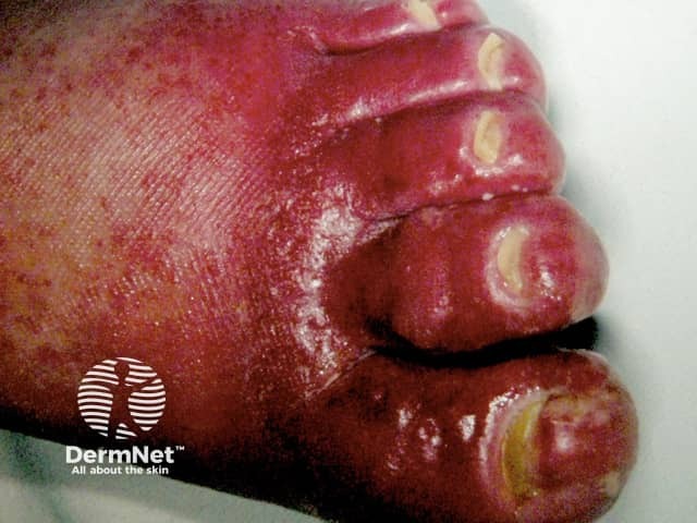 Cellulitis