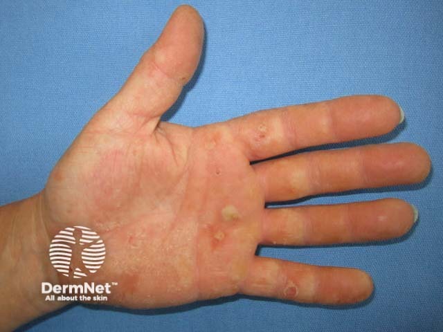 Hand dermatitis due to rubber glove allergy