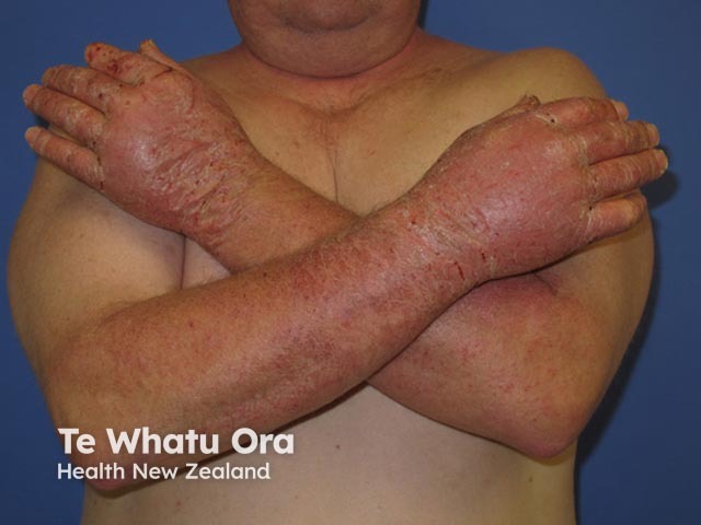 Occupational extensive dermatitis