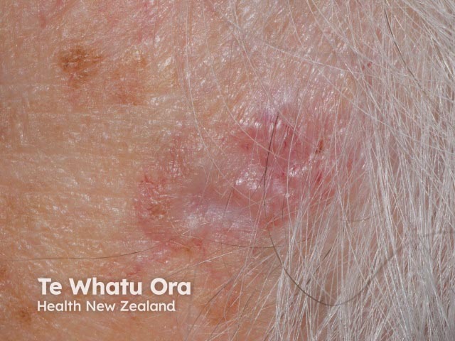 Basal cell carcinoma