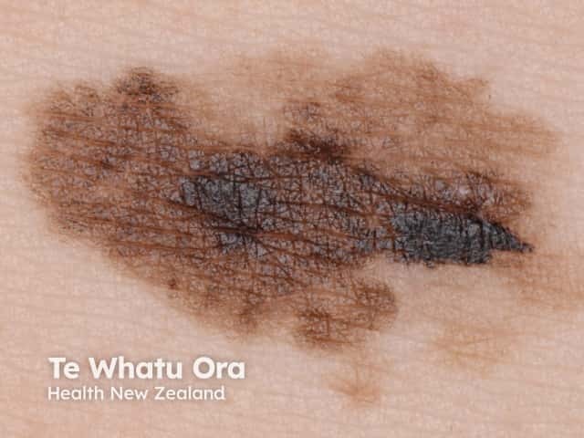 Superficial spreading melanoma