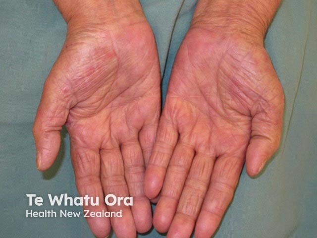 Hand-foot syndrome due to chemotherapy