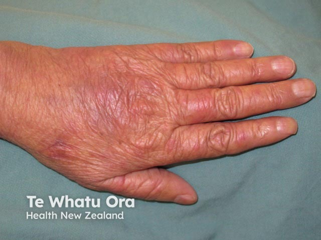 Dorsal hand-foot syndrome due to chemotherapy