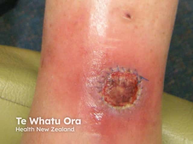 Wound infection