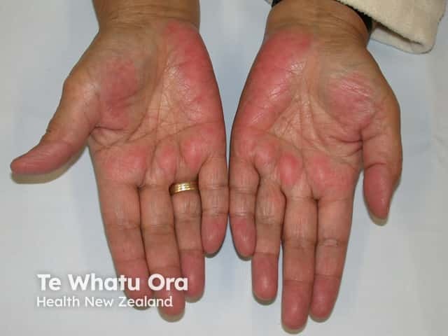 Palmar erythema