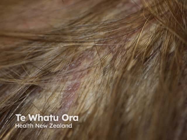 Scalp psoriasis