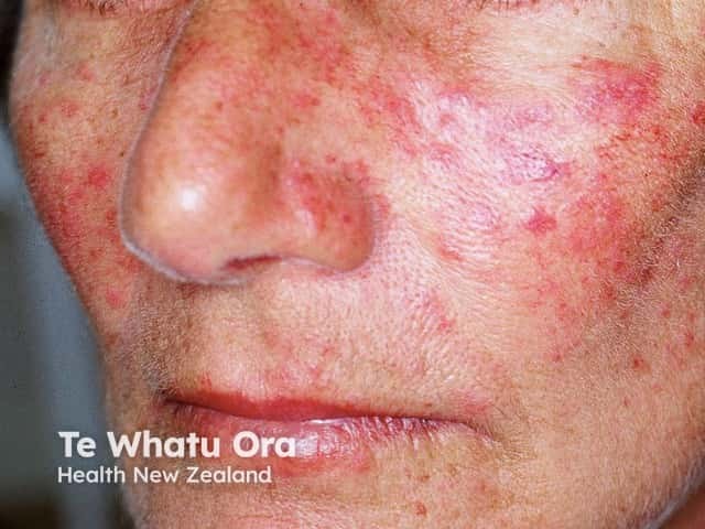 Telangiectatic rosacea