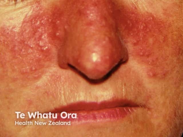 Papulopustular rosacea