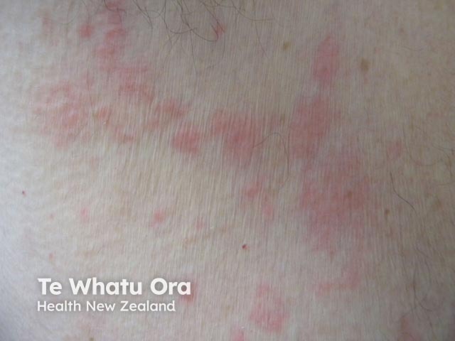 Urticarial dermatitis