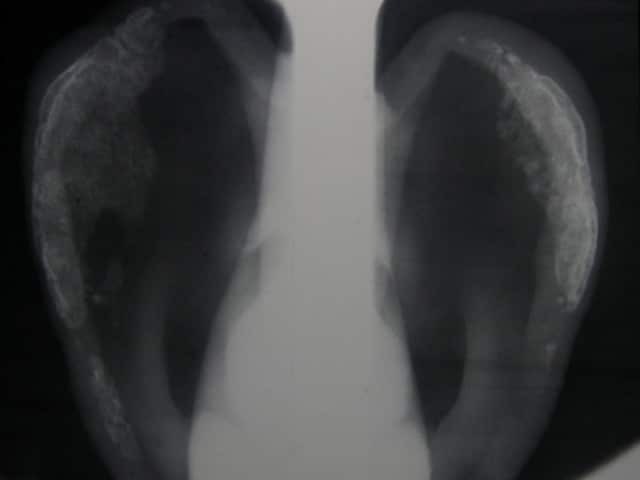 Xray of auricular relapsing polychondritis