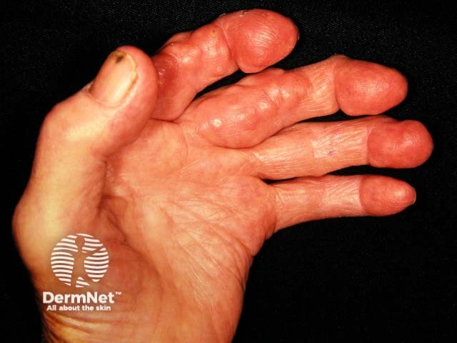 Rheumatoid nodules