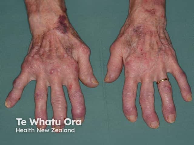 Rheumatoid arthritis