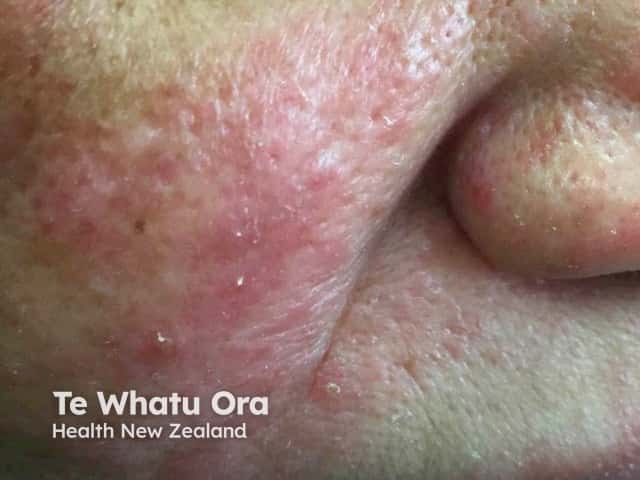 Rosacea due to demodicosis