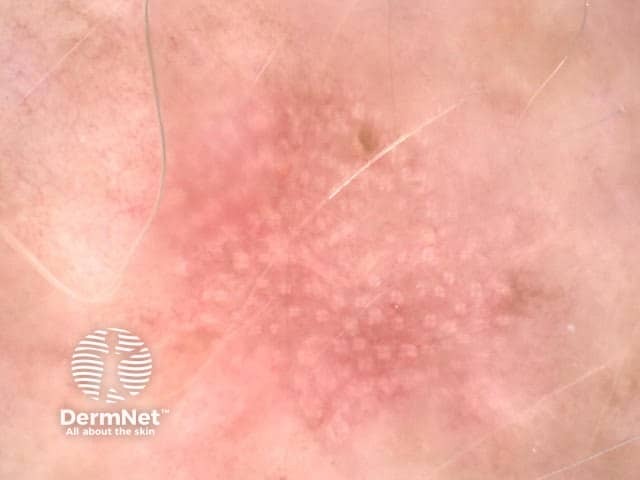 Rosettes in actinic keratosis