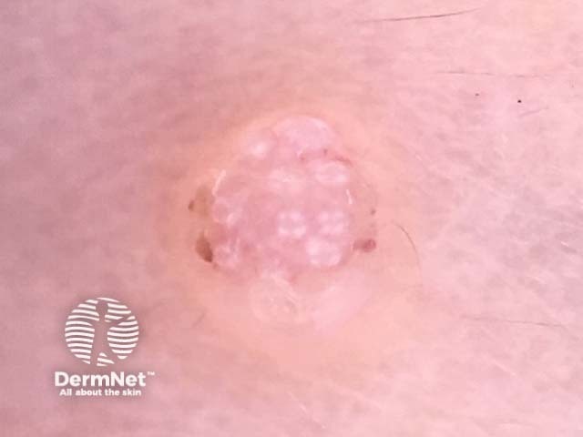 Rosettes in molluscum contagiosum