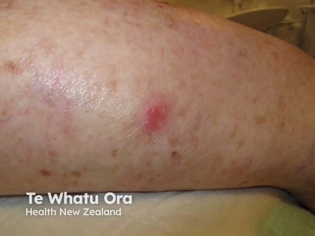 Superficial basal cell carcinoma, arm