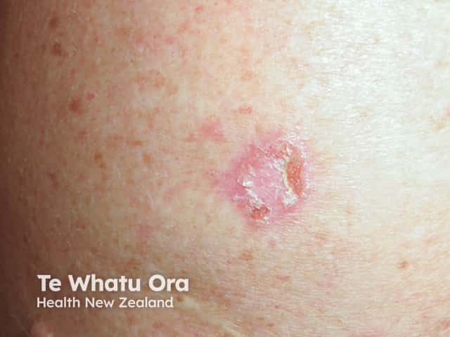 Superficial basal cell carcinoma, arm