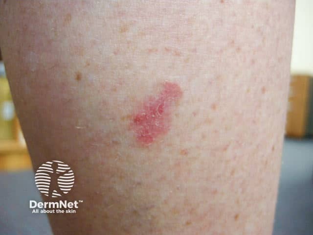 Superficial basal cell carcinoma, leg