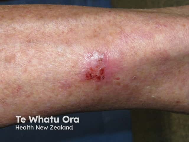 Superficial basal cell carcinoma, leg