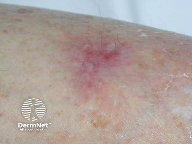 Superficial basal cell carcinoma, leg