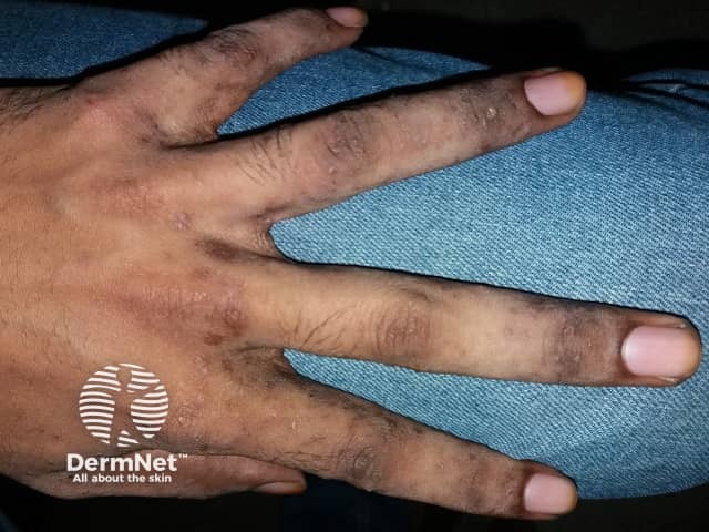 Interdigital burrows due to scabies