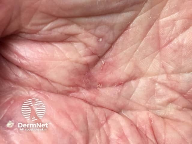 Palmar burrows due to scabies